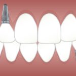 tandarts implantaat