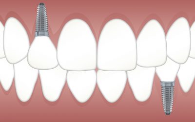 Wanneer laat je implantaten plaatsen en wat zijn de risico’s?